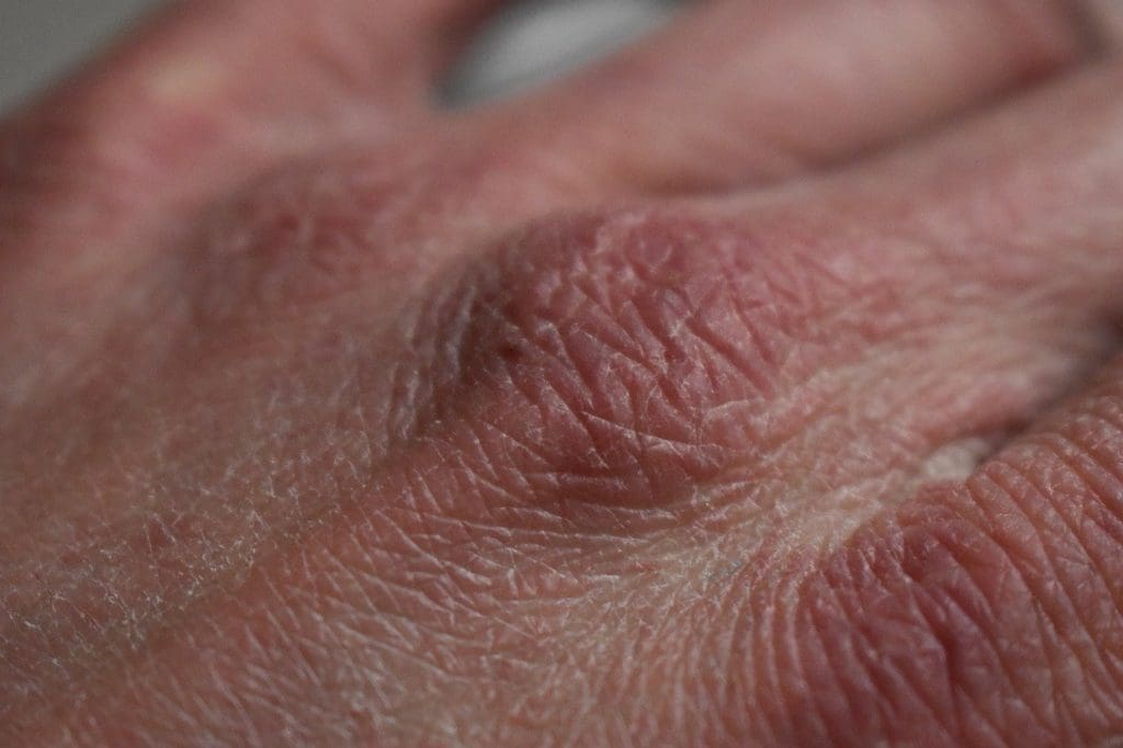 This image shows a dry skin which is related to the article topic "CBD for dry and flaky skin".