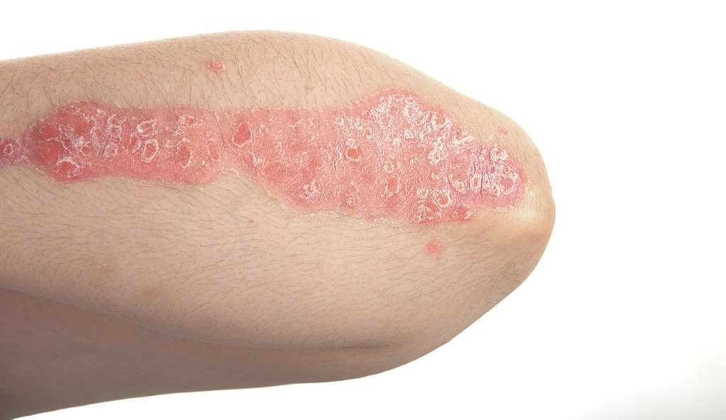 cbd-for-psoriasis