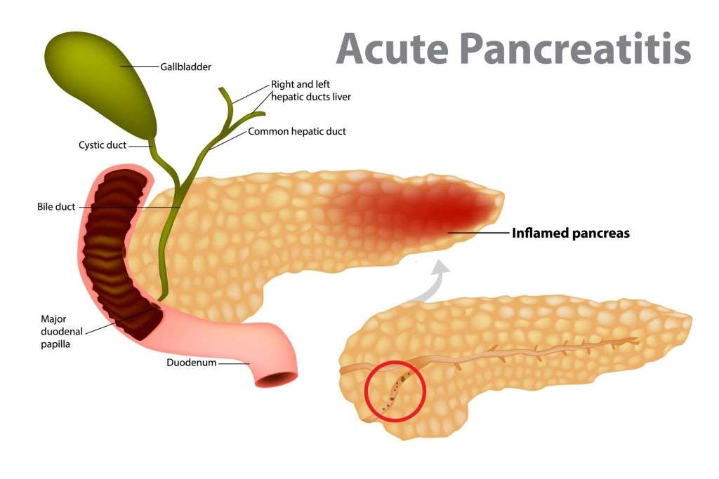 CBD for Pancreatitis